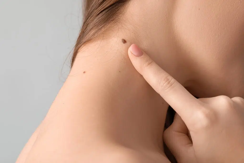 mole