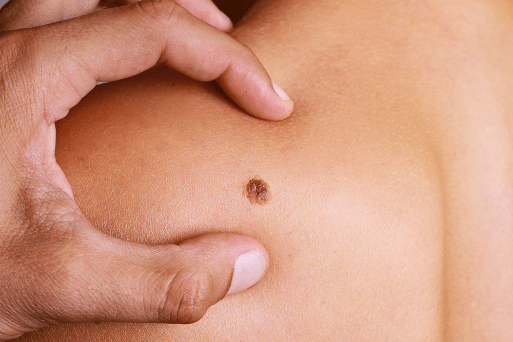 Mole Removal