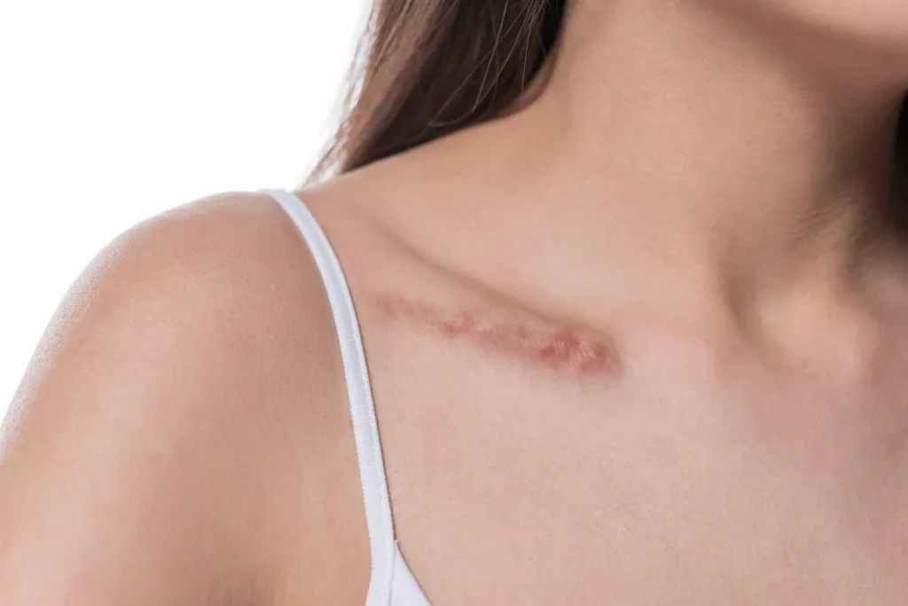 scars