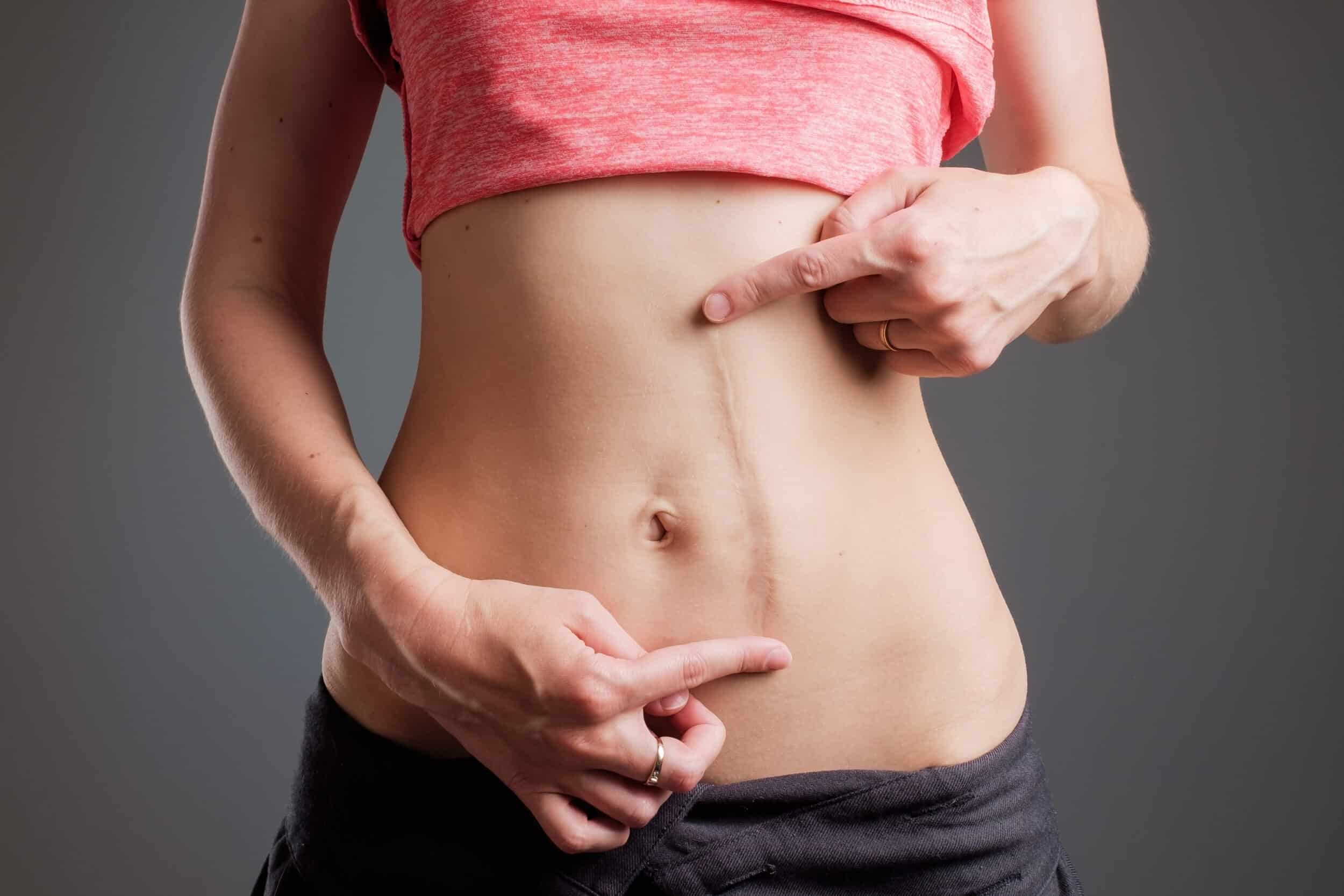 abdominal scar
