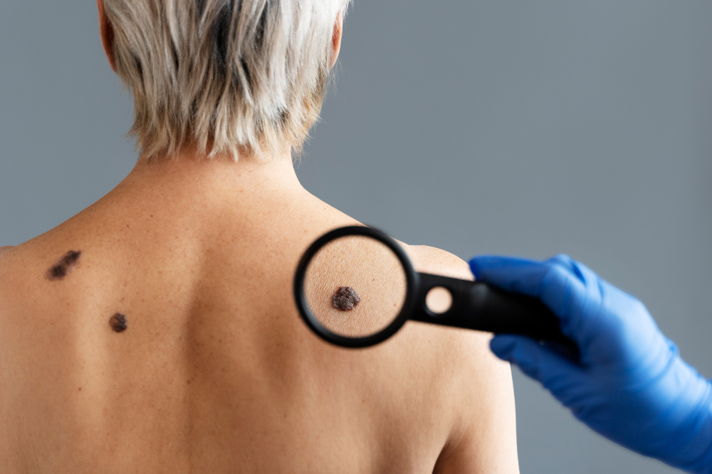 woman showing the back where doctor use magnifying glass to see skin cancer