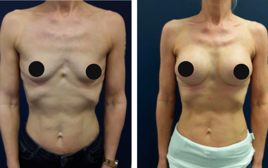 breast implant before and after at lux plastic surgery bedford