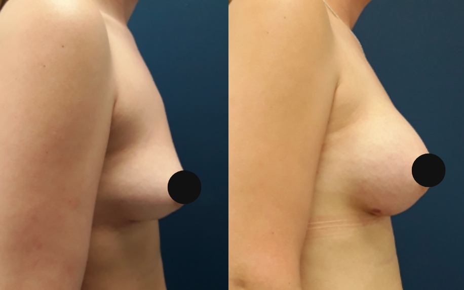 breast implant before and after at lux plastic surgery in bedford