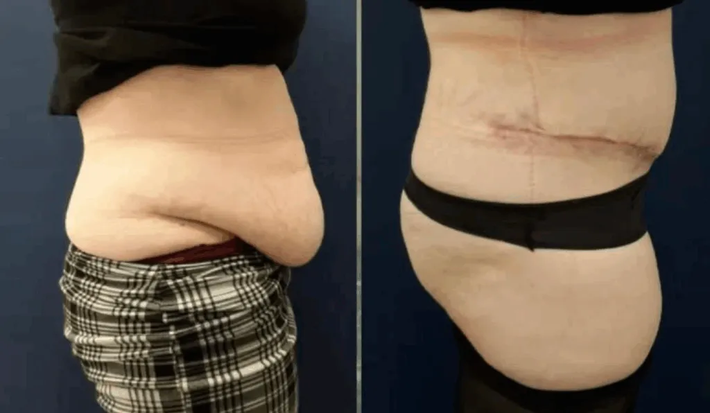 abdominoplasty and liposuction Before and After