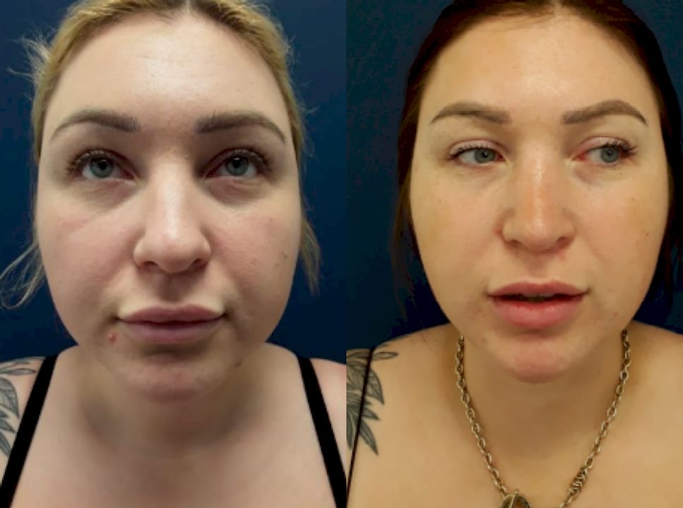 Before and after facial treatments