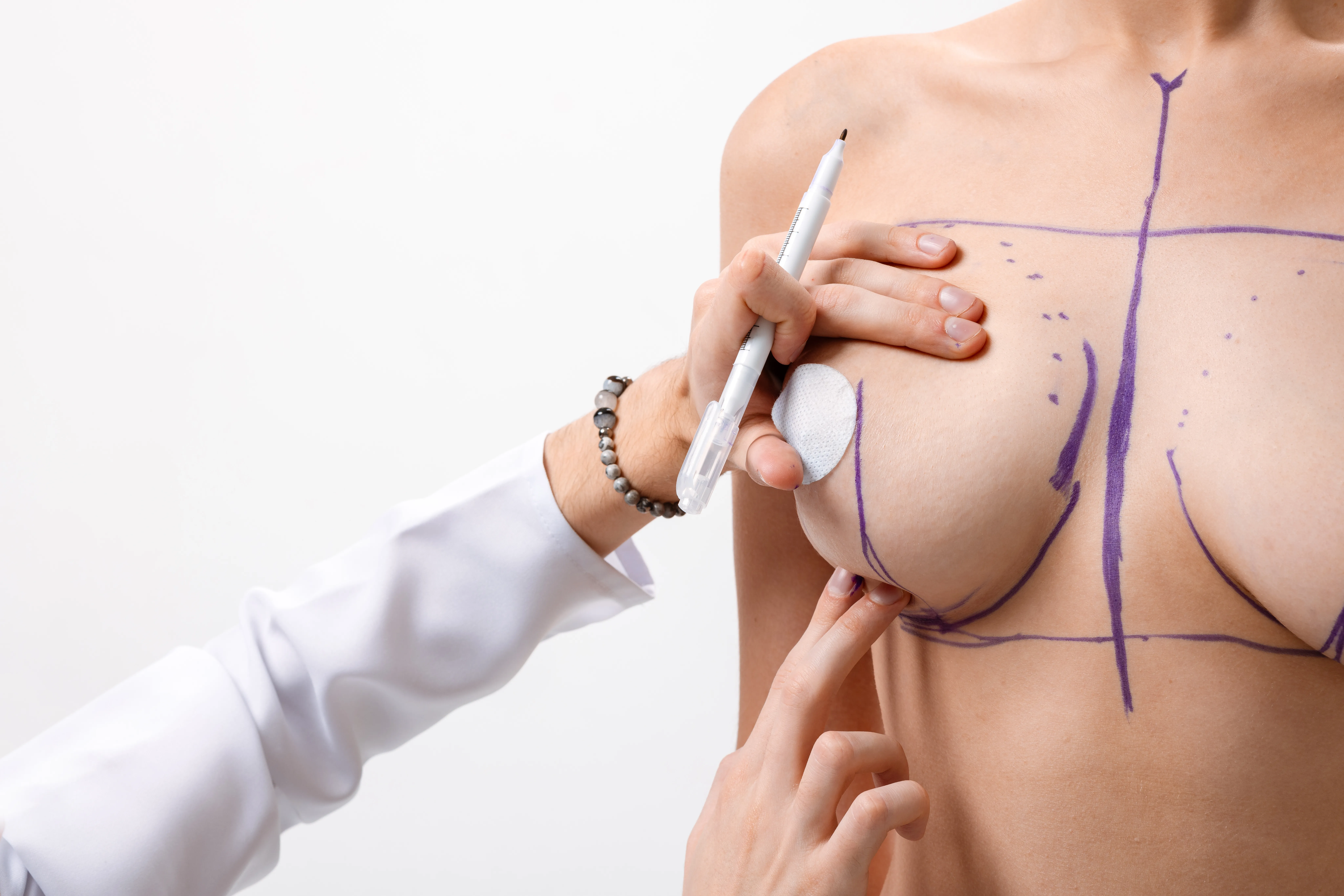 plastic-surgeon-marks-breasts-for-mammoplasty-brea-2026-03-25-22-53-57-utc
