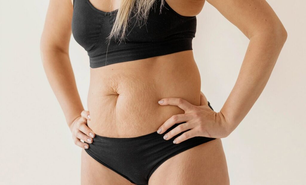 Loose-Skin-After-Pregnancy-