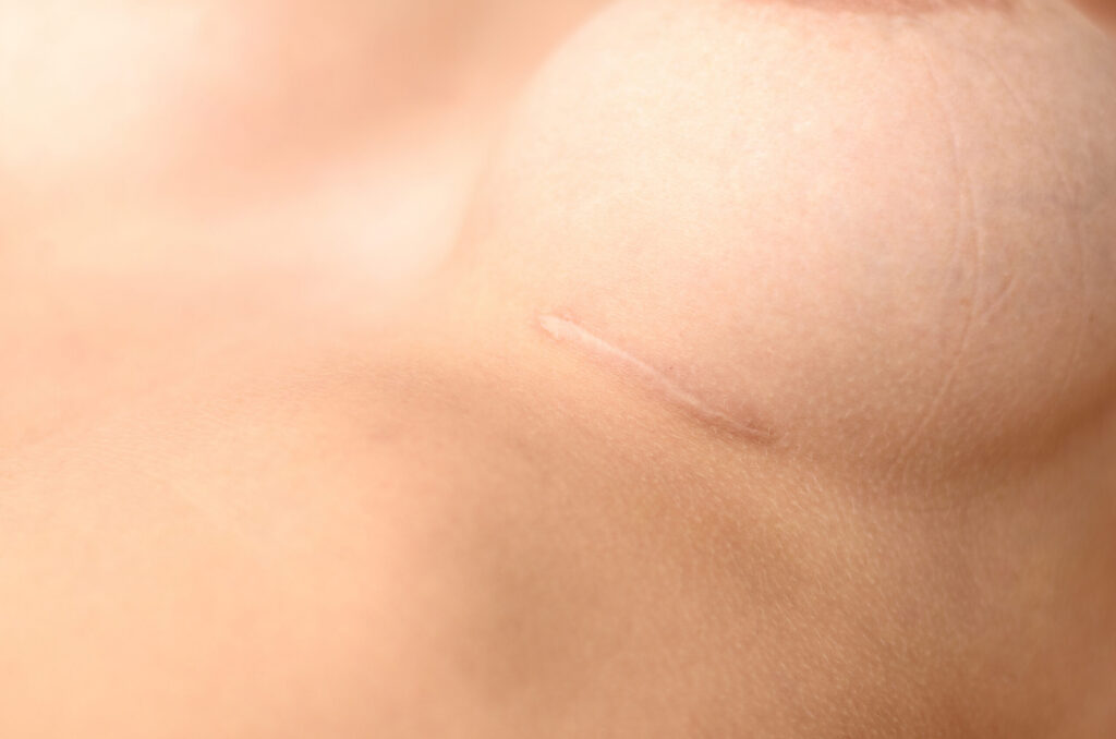 breast scar