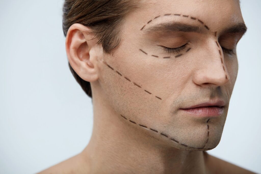 Man with dashed lines drawn on his face marking facelift incisions