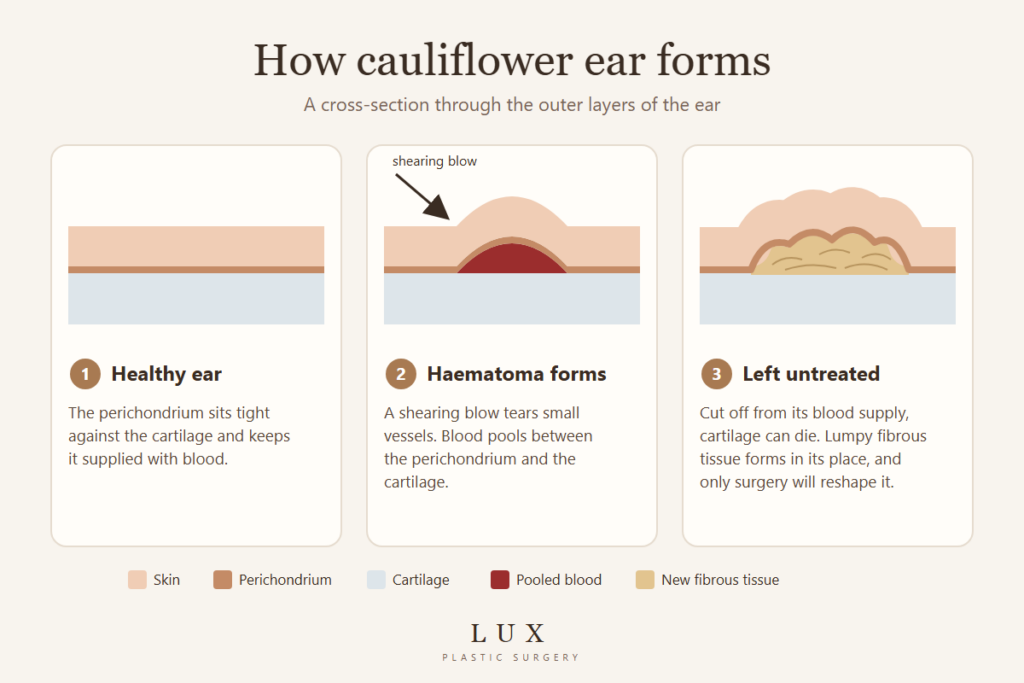 Diagram of how cauliflower ear forms: healthy ear layers, blood pooling between the perichondrium and cartilage, then lumpy fibrous tissue if left untreated