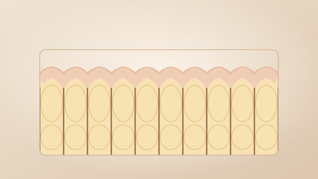 Illustration of skin over fat held down by parallel fibrous bands, causing a dimpled surface