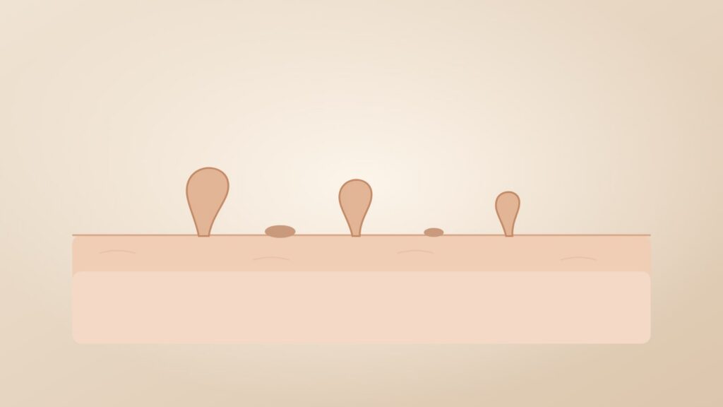 Illustration of skin tags hanging from the skin surface on narrow stalks