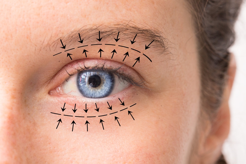 Close-up of an eye with arrows marking the upper and lower lids