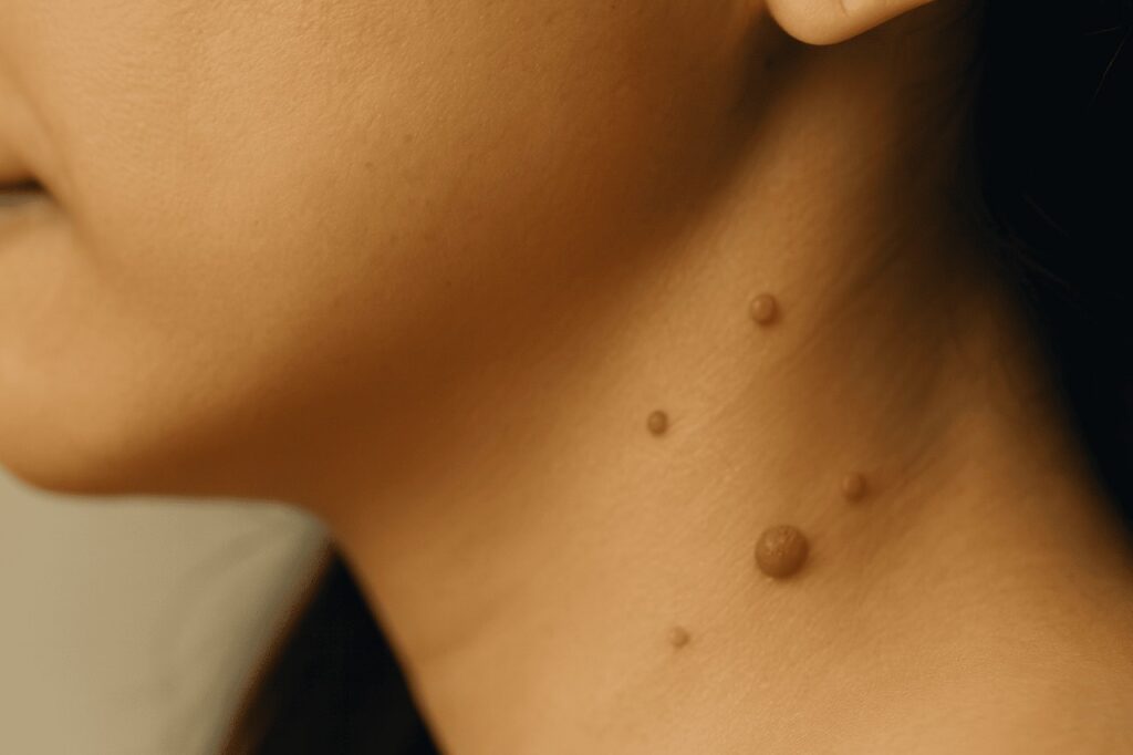 Several skin tags on the side of a woman's neck